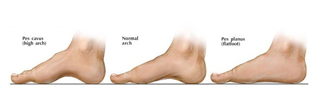 high arch foot support